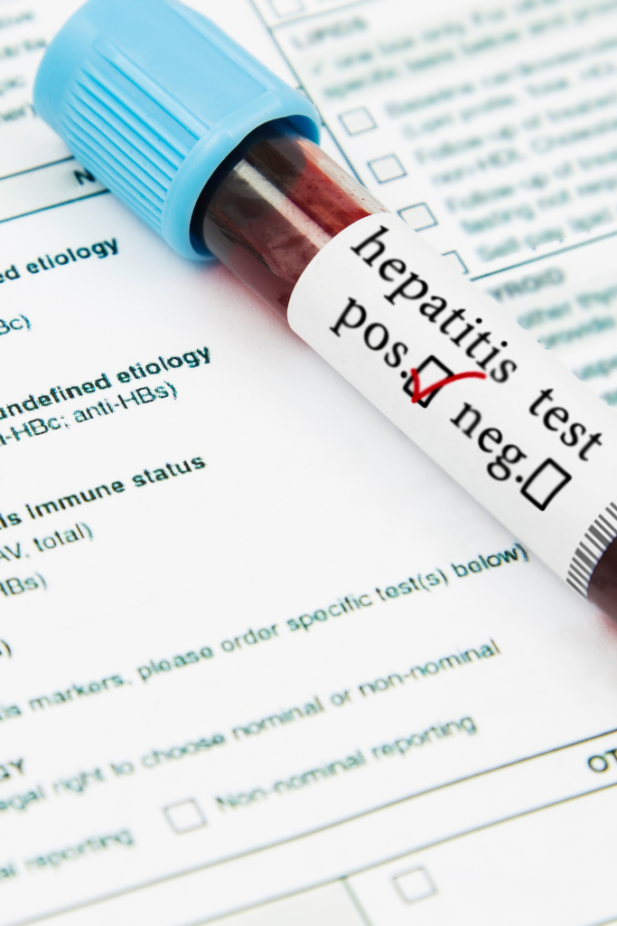 Tests for the diagnosis of autoimmune hepatitis