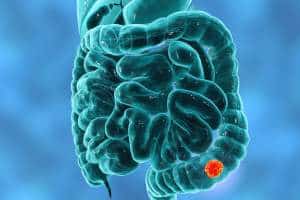 Gastric Cancer Symptoms IMG 5