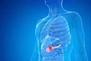 Gastric Cancer Symptoms IMG 6