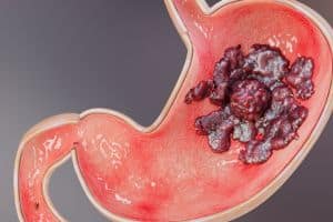 Gastric Cancer Symptoms IMG 7